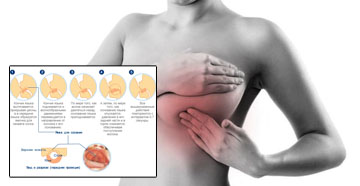 Причины болей в груди при грудном вскармливании: как лечить
